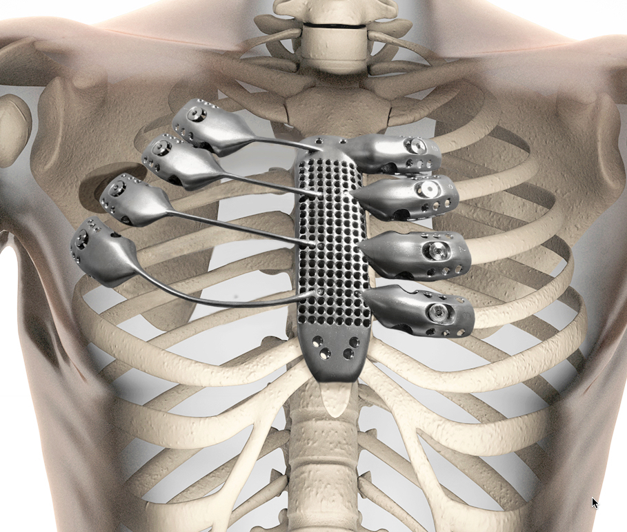 3D-printed sternum