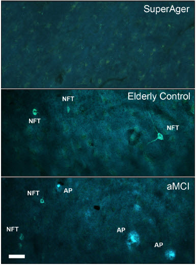 Thioflavin-S staining of NFTs and APs