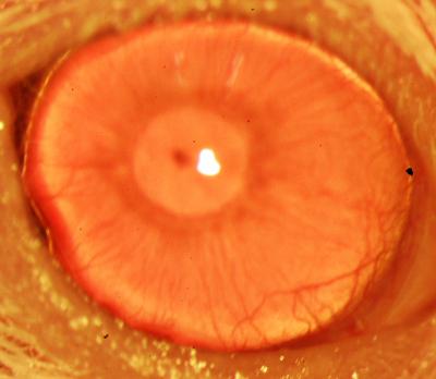 restored-functional-cornea