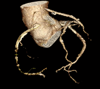 3D static CTA reconstructions