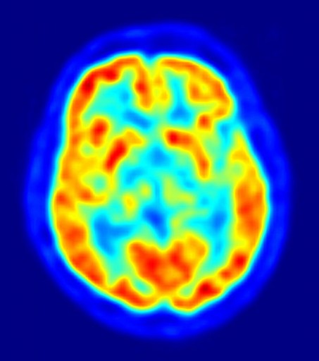 531px-PET-image-human-brain