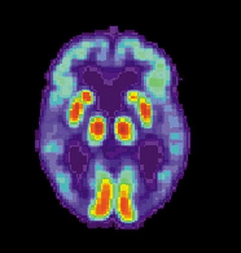 572px-PET_Alzheimer