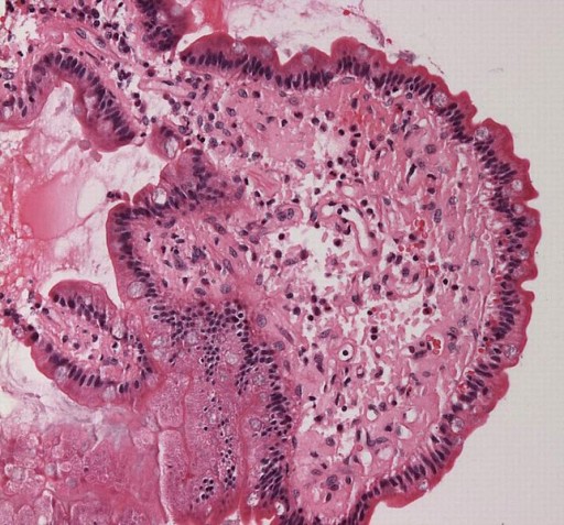 Small_bowel_duodenum_with_amyloid_deposition_20X