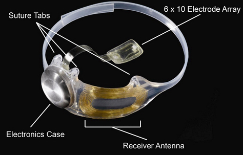 Argus II implanted
