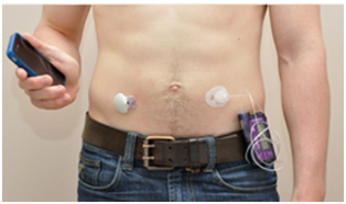 Artificial Pancreas