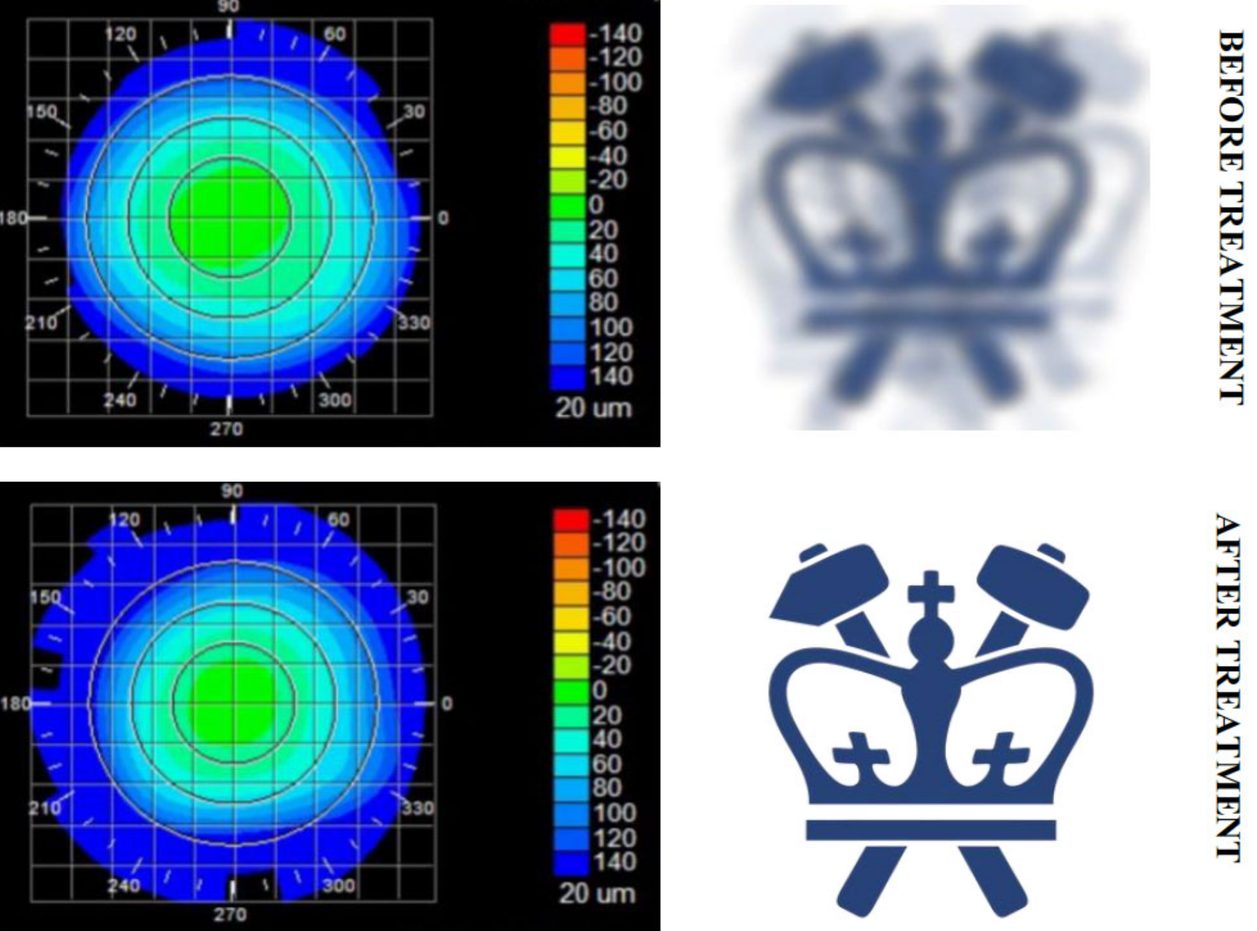Corneal laser treatment