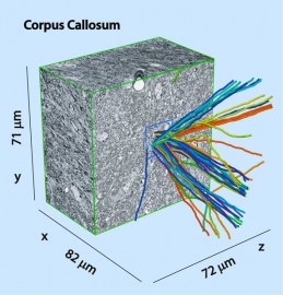 Corpus Callosum