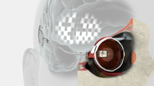Early bionic eye prototype drawing (credit: Bionics Institute)