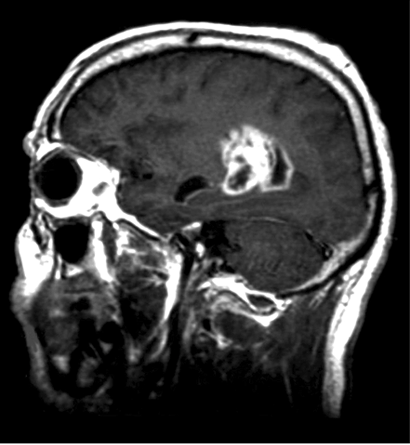 GBM MRI Scan GBM MRI Scan