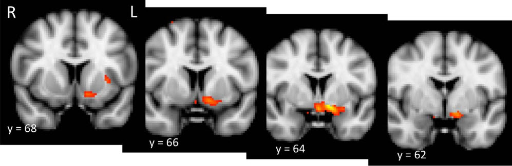 Left-nucleus-accumbens