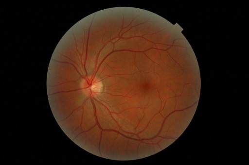 Left_Eye_Retina