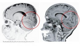 Occipital-Region Occipital Region