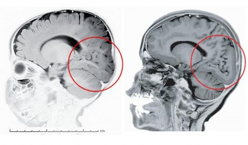 Occipital Region