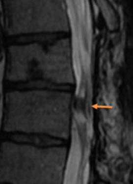 Post-op spinal cord