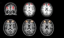 Prefrontal Cortex