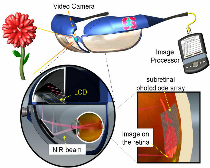 Retinal_prosthesis design