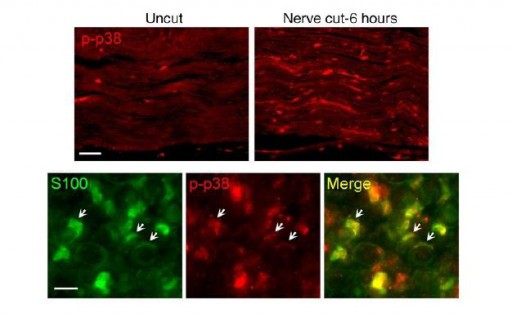 Schwann_cell_demyelination