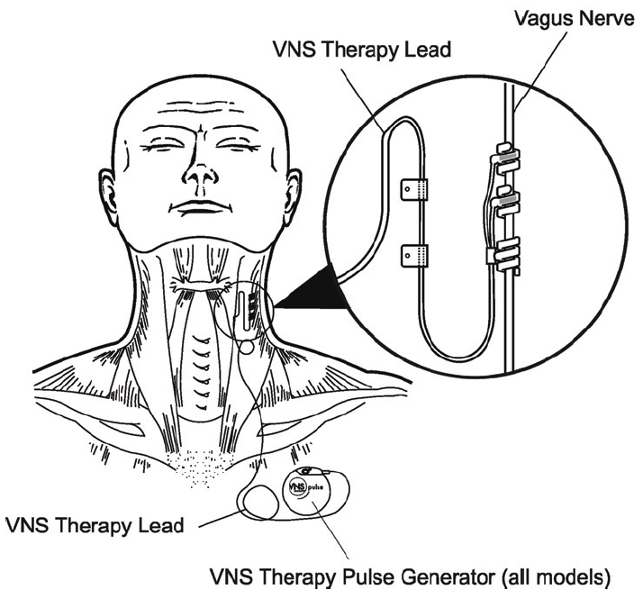 VNS device