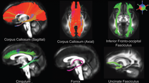 White matter (WM) tract reconstructions