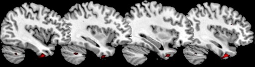 anterior temporal cortex_slices