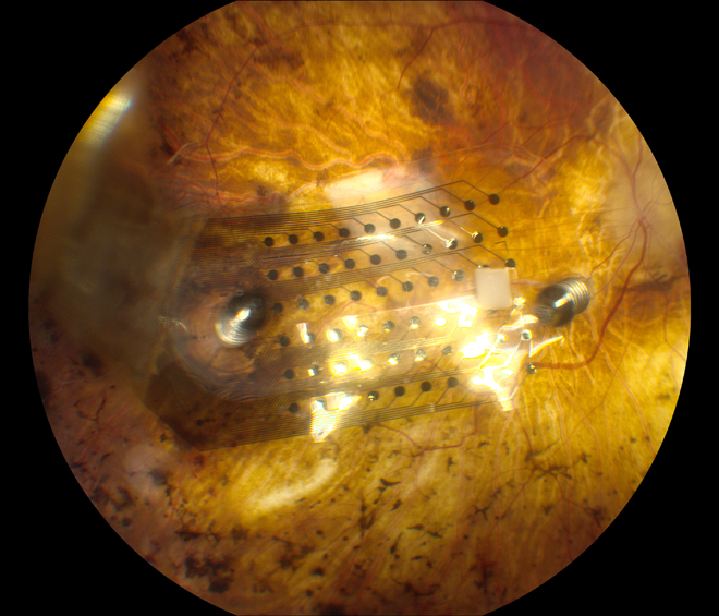 argus_implant
