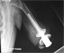 artificial limb