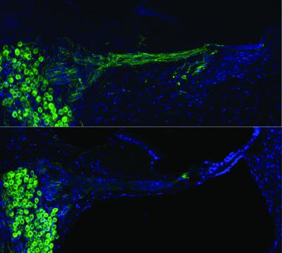 auditory-nerves-after-gene-therapy