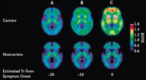 bateman_alzheimer