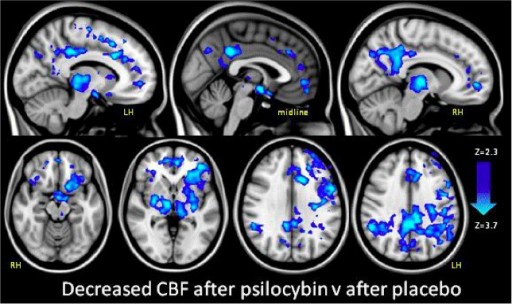 brain_psilocybin