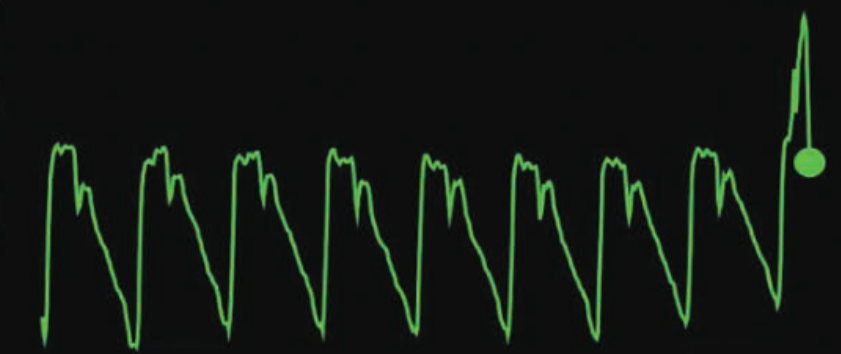 carotid arterial waveform