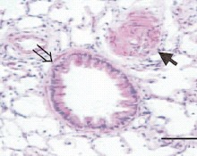 Pulmonary hypertension – note hypertrophy Pulmonary hypertension – note hypertrophy