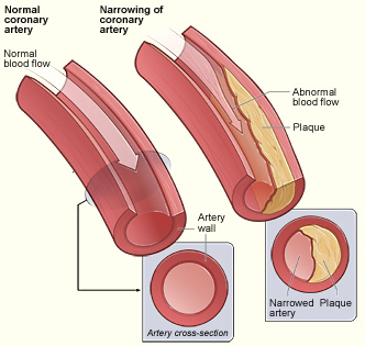 coronary artery