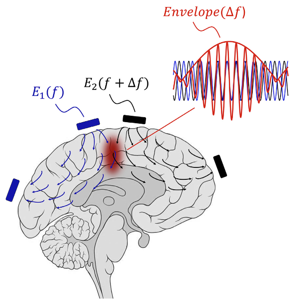 deep brain stimulation