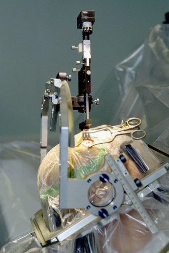 deepbrainstimulation