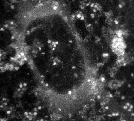 ferritin
