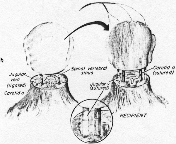 head transplant