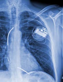 Implanted cardiac defibrillator Implanted cardiac defibrillator