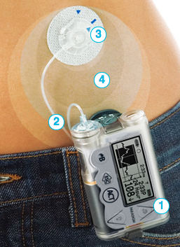 insulin pump therapy