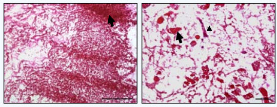 kidney clotting