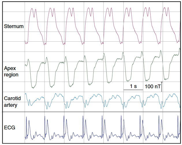 magnetic field recordings of cardiac activity