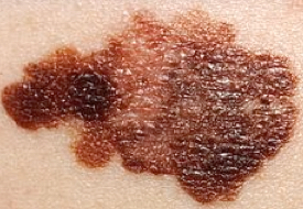 melanoma