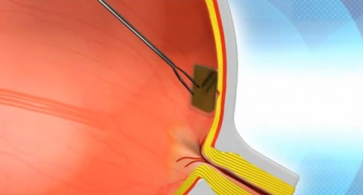 nano_retina