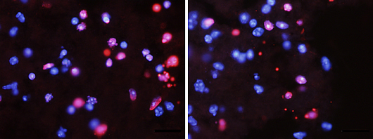 p45_spinal_cord_injury