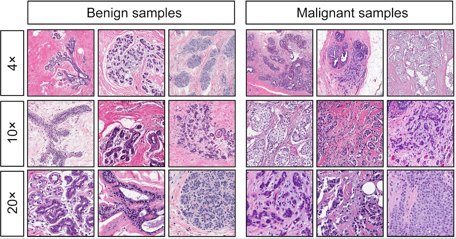 breast-cancer images