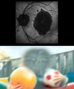 retina_AMD
