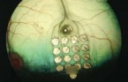 retinal_implant