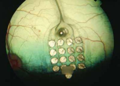 retinal_implant retinal_implant