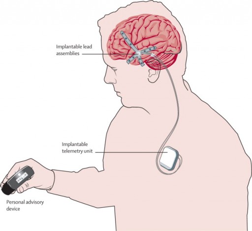 seizure_advisory_system