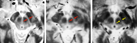 substantia_nigra_mit substantia_nigra_mit
