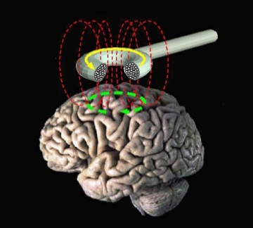 transcranial_stimulation